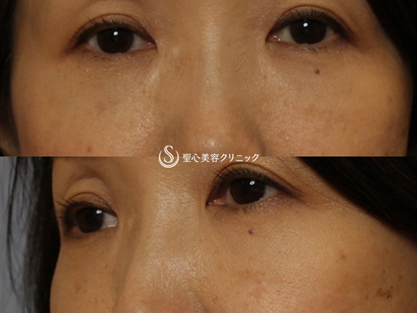【50代女性・目の下の若返り】プレミアムPRP皮膚再生療法（3ヶ月後） After 