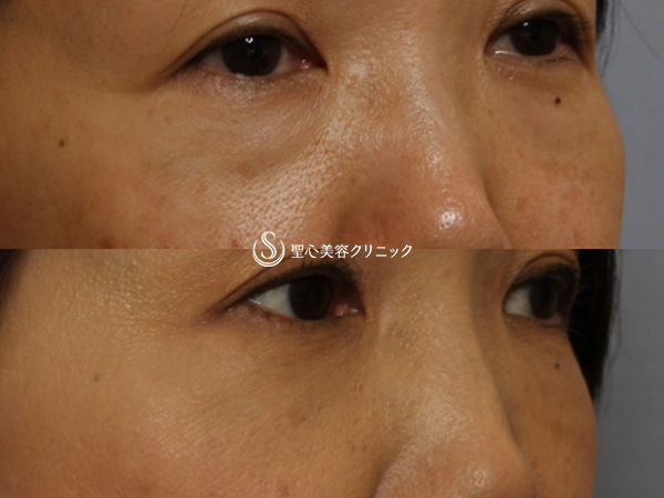 【50代女性・目の下の若返り】プレミアムPRP皮膚再生療法（3ヶ月後） After 
