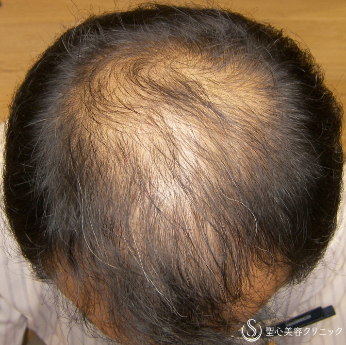 【60代男性・AGA】プレミアム・グロースファクター毛髪再生療法（16回後） Before 