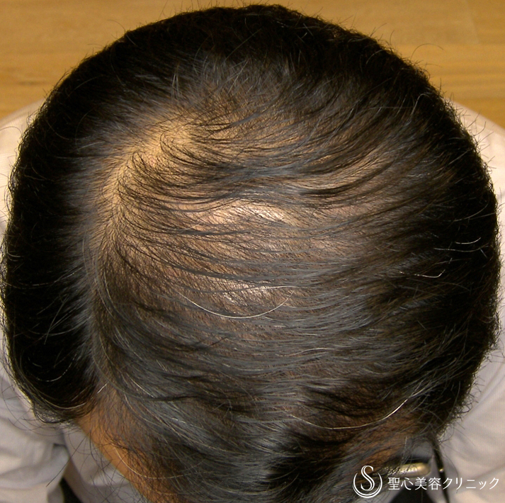 【60代男性・AGA】プレミアム・グロースファクター毛髪再生療法（16回後） After 