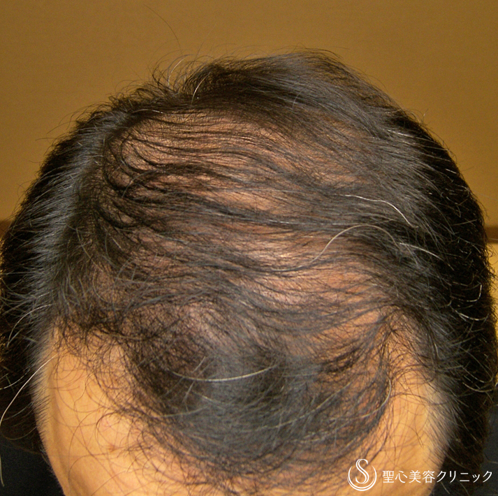 【60代男性・AGA】プレミアム・グロースファクター毛髪再生療法（16回後） Before 