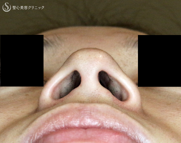 【20代女性・存在感のある鼻】小鼻縮小術+α法「Ver.3」（1ヶ月半後）札幌院 Before 