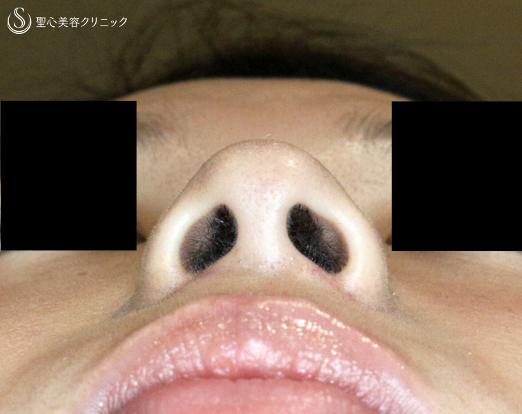 【20代女性・存在感のある鼻】小鼻縮小術+α法「Ver.3」（1ヶ月半後）札幌院 After 