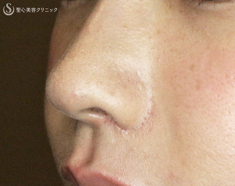 【20代女性・存在感のある鼻】小鼻縮小術+α法「Ver.3」（1ヶ月半後）札幌院 After 