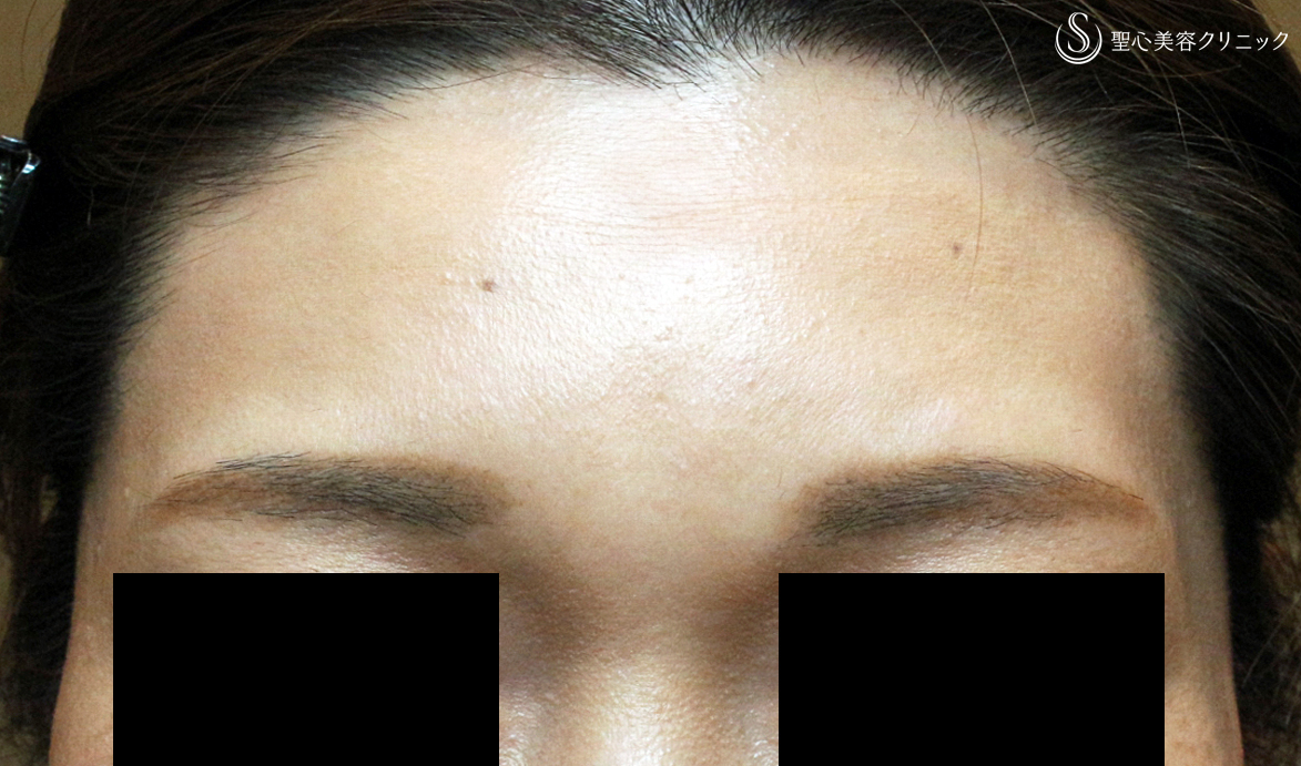 【40代女性・眉間に注入6年後→こめかみで仕上げ】プレミアムPRP皮膚再生療法（6年後） Before 