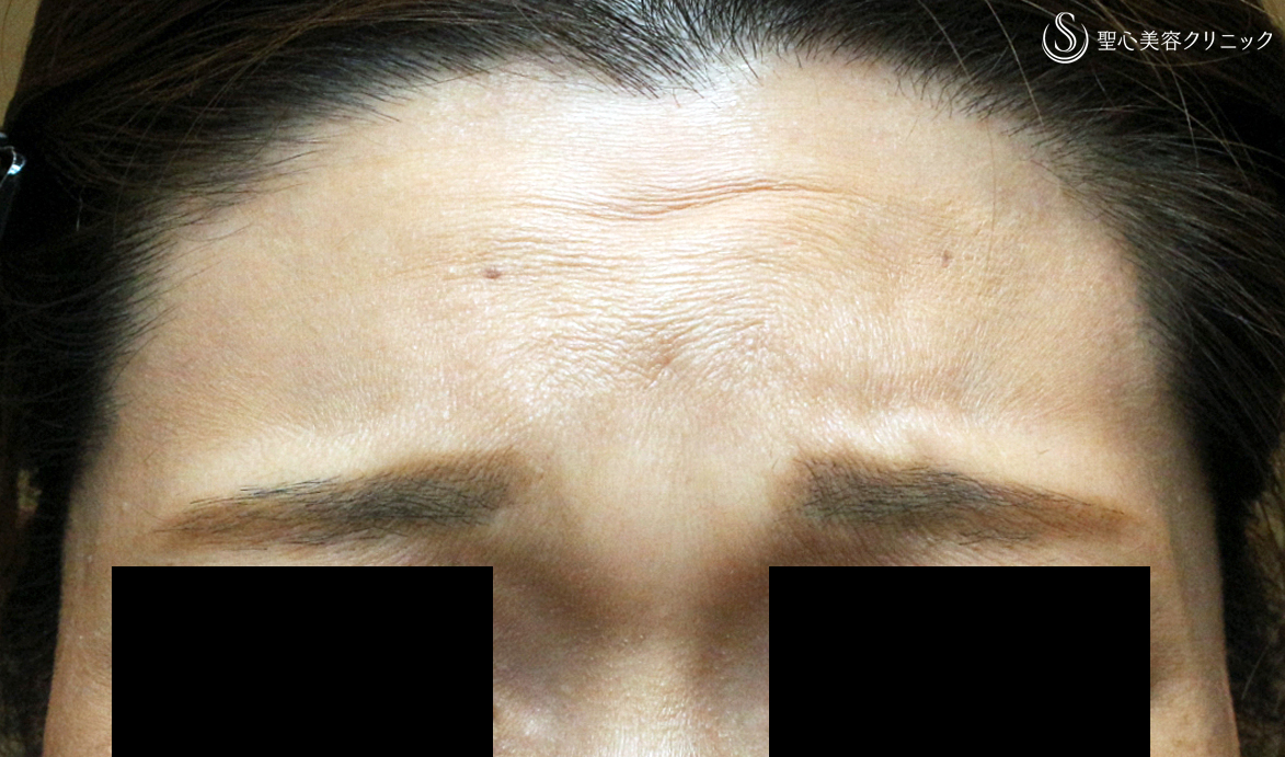 【40代女性・眉間に注入6年後→こめかみで仕上げ】プレミアムPRP皮膚再生療法（6年後） After 