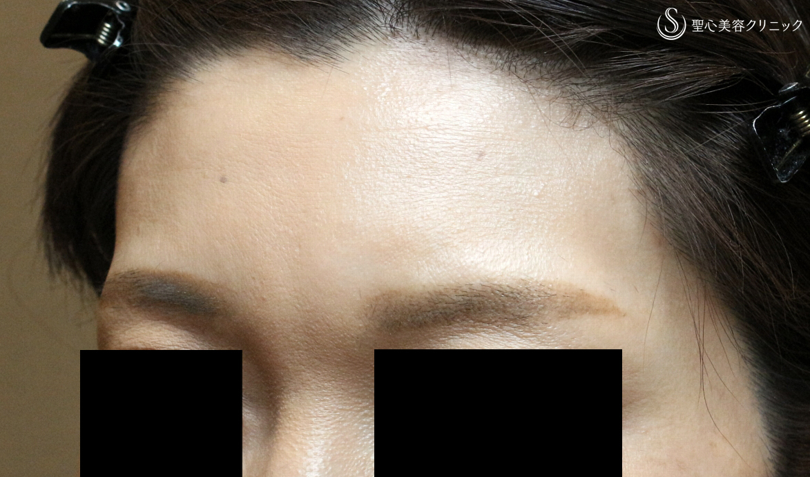 【40代女性・眉間に注入6年後→こめかみで仕上げ】プレミアムPRP皮膚再生療法（6年後） Before 