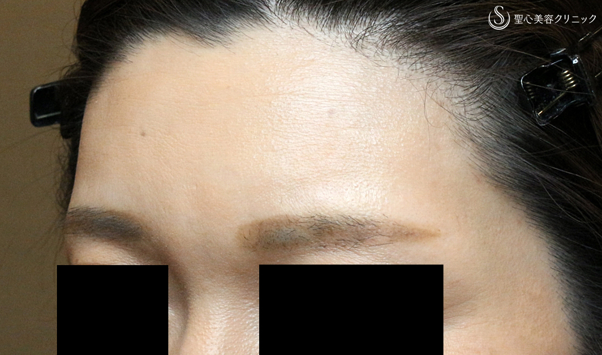 【40代女性・眉間に注入6年後→こめかみで仕上げ】プレミアムPRP皮膚再生療法（6年後） After 