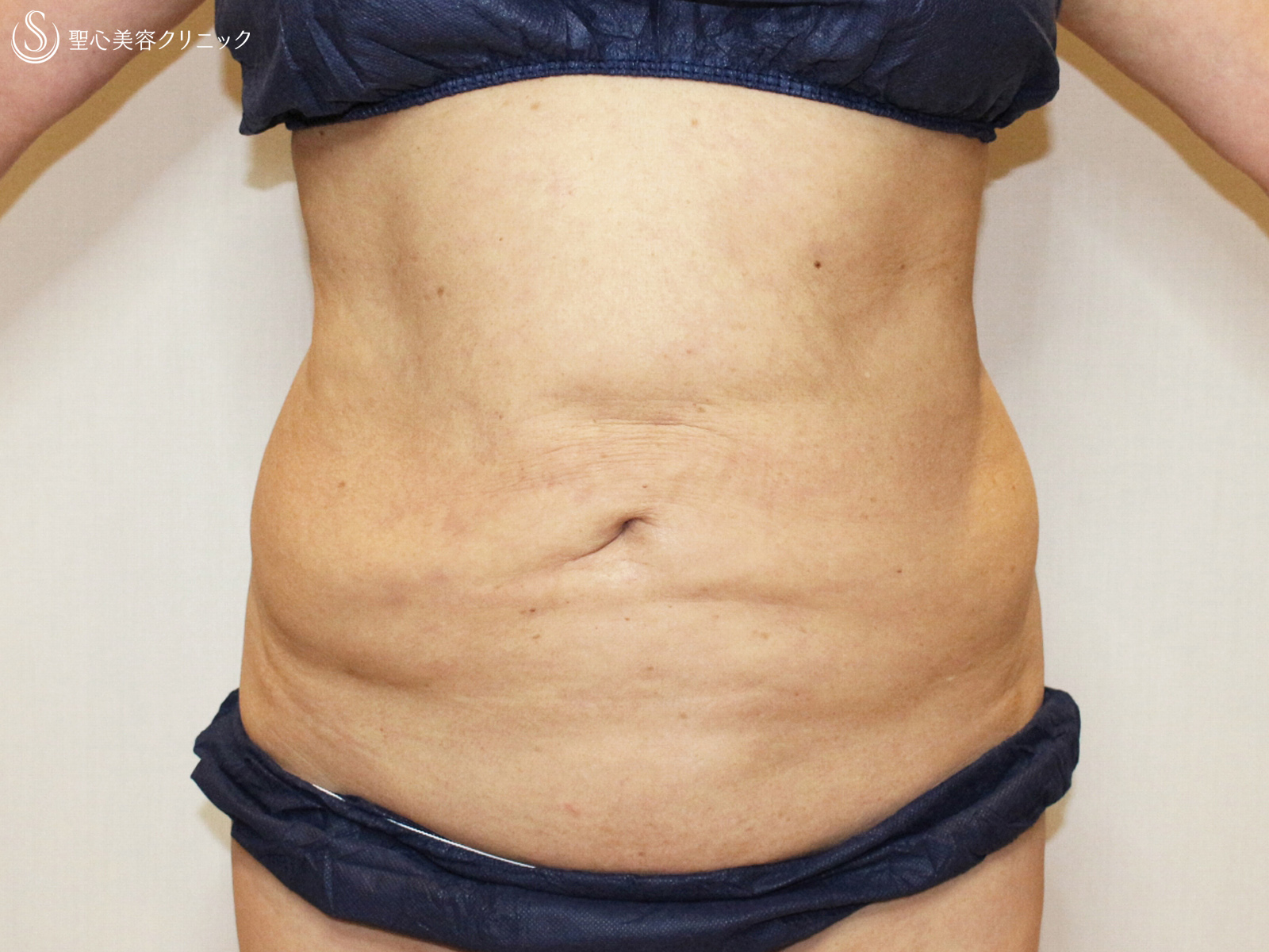 【50代女性・確かに効果的ですが...】切らないリポセル（3ヶ月後） Before 