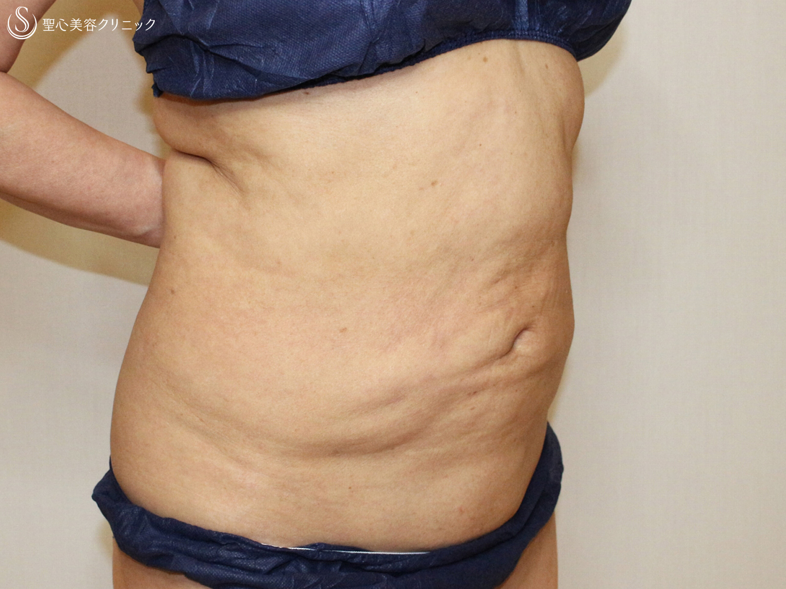 【50代女性・確かに効果的ですが...】切らないリポセル（3ヶ月後） Before 