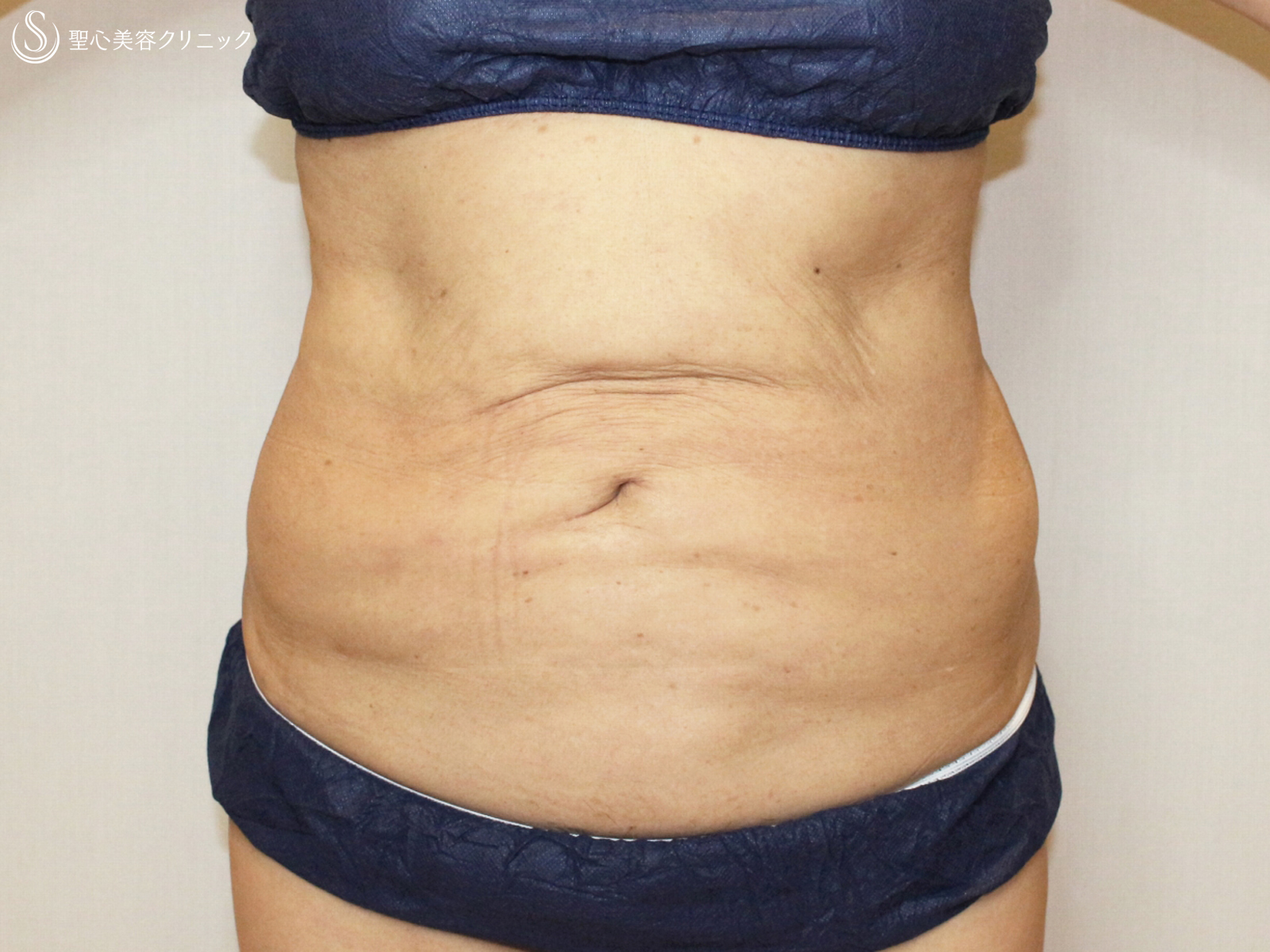 【50代女性・確かに効果的ですが...】切らないリポセル（3ヶ月後） After 