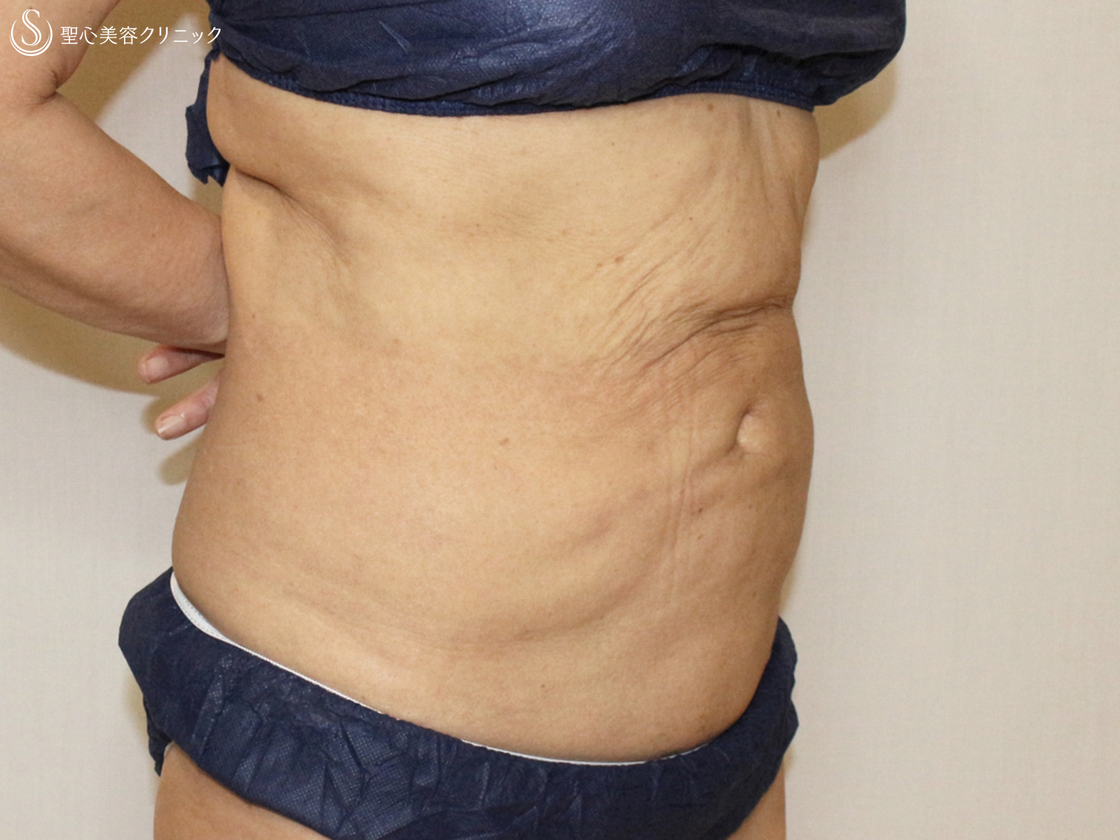 【50代女性・確かに効果的ですが...】切らないリポセル（3ヶ月後） After 