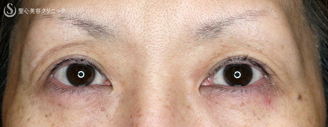 【50代女性・凹み目＆タルミもあり】切らない眼瞼下垂+α法（1年後）札幌院 After 
