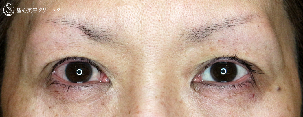 【50代女性・凹み目＆タルミもあり】切らない眼瞼下垂+α法（1年後）札幌院 Before 