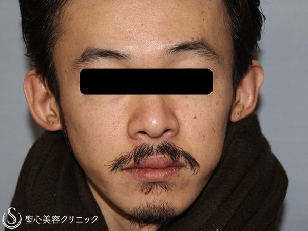 【30代男性・立ち耳】立ち耳修正（埋没法）（3ヶ月後） After 