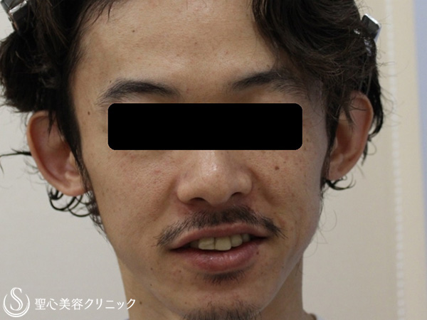 【30代男性・立ち耳】立ち耳修正（埋没法）（3ヶ月後） Before 