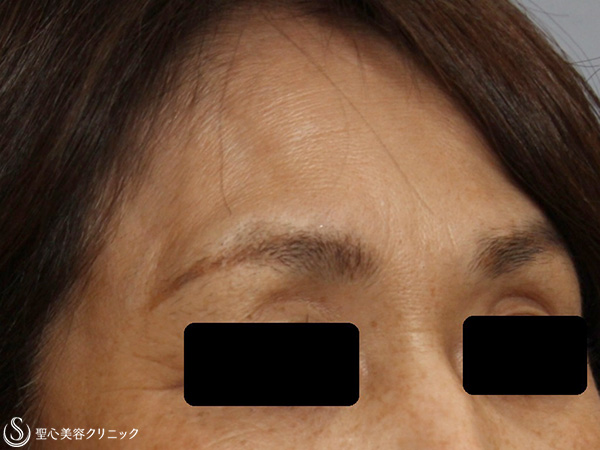 【50代女性・額のしわ改善】プレミアムPRP皮膚再生療法（施術直後） Before 