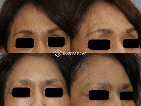 【50代女性・額のしわ改善】プレミアムPRP皮膚再生療法（施術直後） After 
