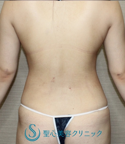 【20代女性・マイナス12cmダウン】ベイザーリポ脂肪吸引（腹部）（3ヶ月後） After 
