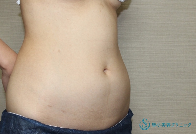 【30代女性・腹部の脂肪吸引】ベイザーリポ脂肪吸引（2年後） Before 