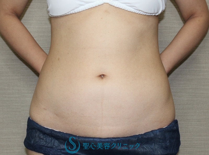 【30代女性・腹部の脂肪吸引】ベイザーリポ脂肪吸引（2年後） Before 