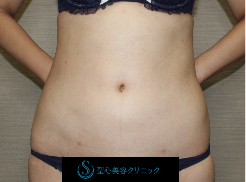【30代女性・腹部の脂肪吸引】ベイザーリポ脂肪吸引（2年後） After 