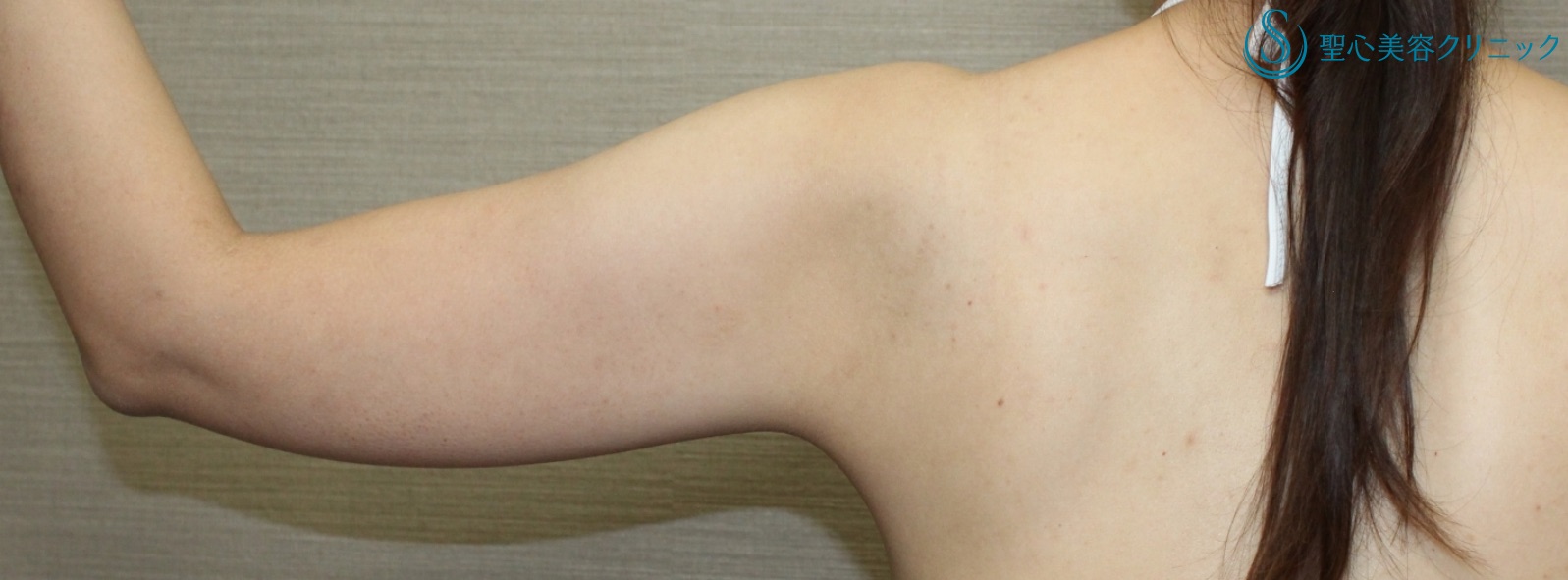 【30代女性・二の腕の脂肪吸引】ベイザーリポ脂肪吸引（10ヶ月後） Before 