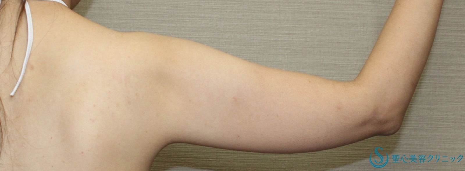 【30代女性・二の腕の脂肪吸引】ベイザーリポ脂肪吸引（10ヶ月後） Before 
