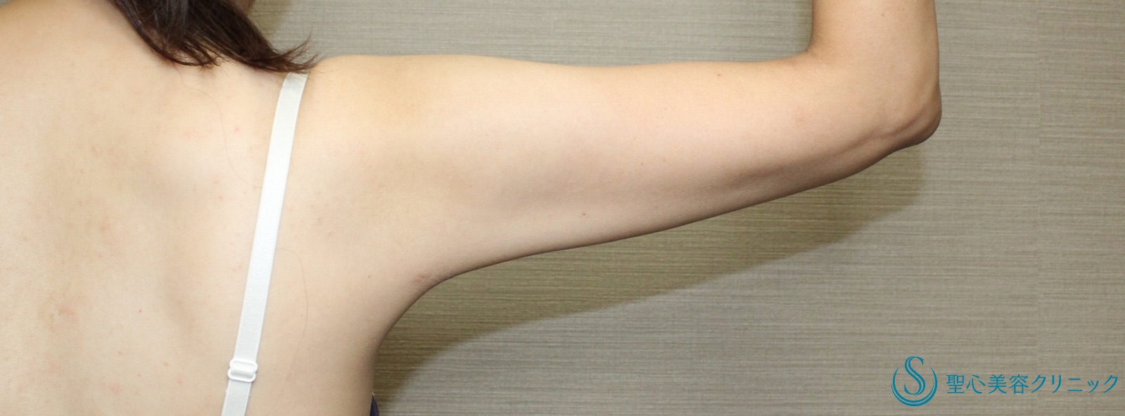 【30代女性・二の腕の脂肪吸引】ベイザーリポ脂肪吸引（10ヶ月後） After 