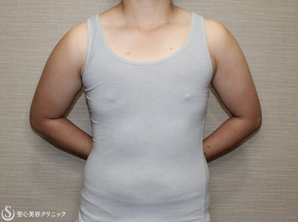 【20代女性・性同一性障害（FTM）】ベイザー脂肪吸引＋乳腺切除（4ヶ月後） After 