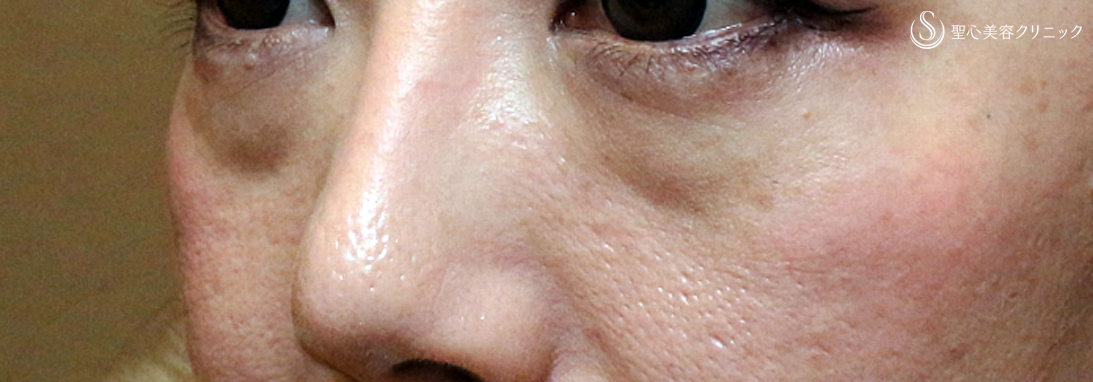 【30代女性・目の下のクマを注入だけで】プレミアムPRP皮膚再生療法（1年3ヶ月後） Before 