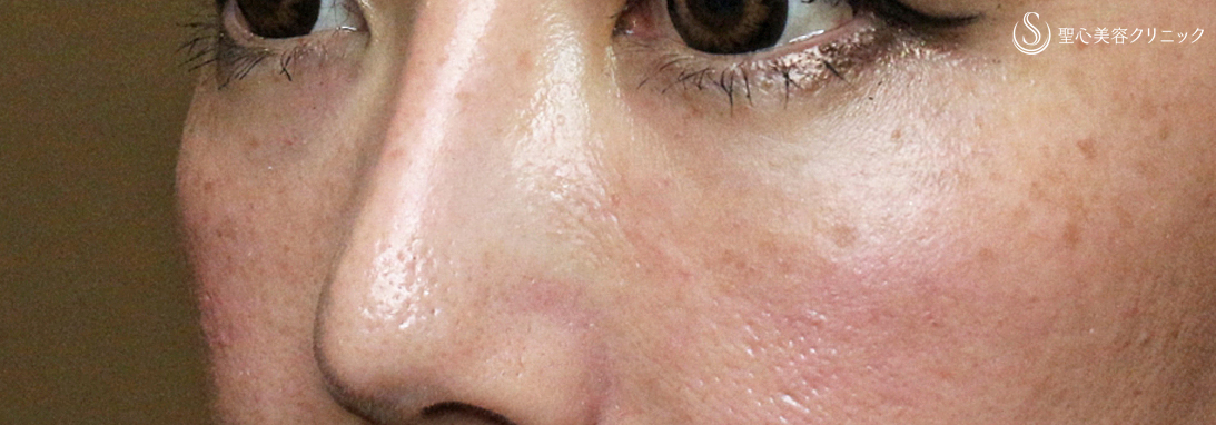 【30代女性・目の下のクマを注入だけで】プレミアムPRP皮膚再生療法（1年3ヶ月後） After 