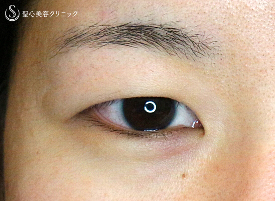 【20代女性・厚いまぶた】マイクロメソッド+α法（3点留め）3ヶ月後 Before 