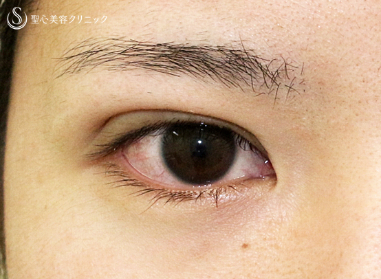 【20代女性・厚いまぶた】マイクロメソッド+α法（3点留め）3ヶ月後 Before 