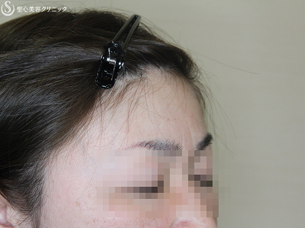 【40代女性・額を丸く】プレミアムPRP皮膚再生療法 Before 