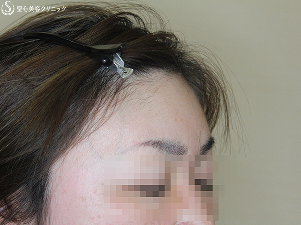 【40代女性・額を丸く】プレミアムPRP皮膚再生療法 After 
