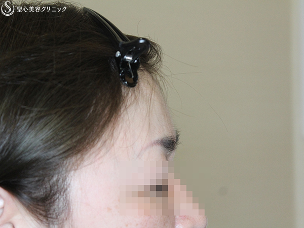 【40代女性・額を丸く】プレミアムPRP皮膚再生療法 Before 