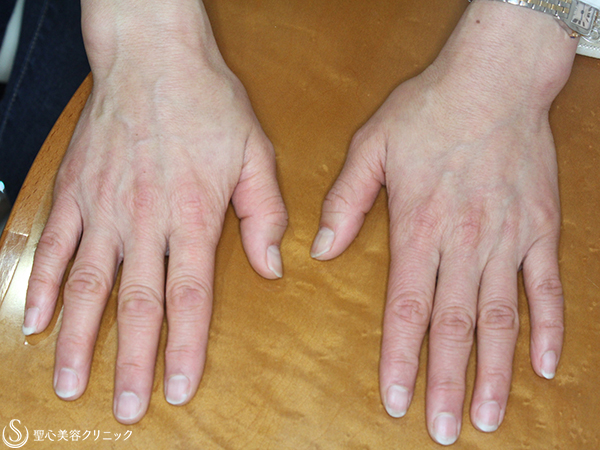 【50代女性・手の甲の若返り】プレミアムPRP皮膚再生療法 After 