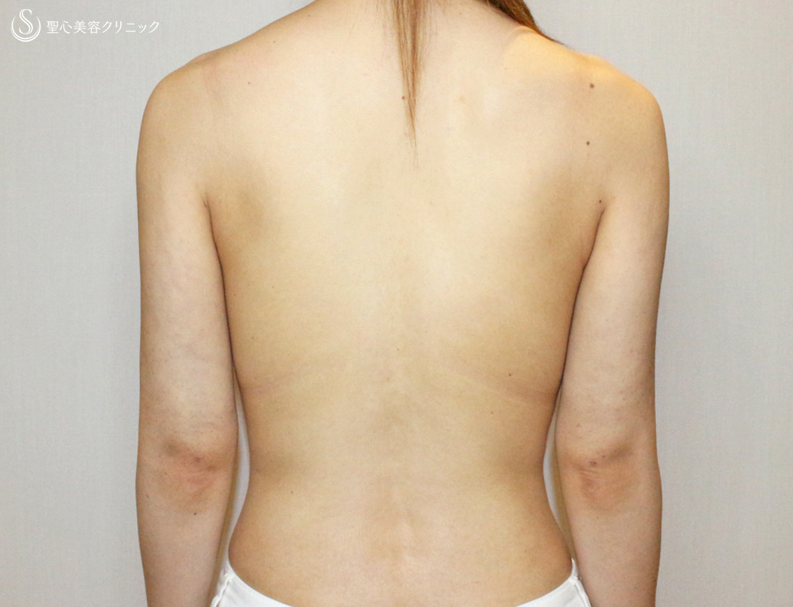 【30代女性・二の腕を綺麗に細く】ベイザー脂肪吸引（1ヶ月後） After 