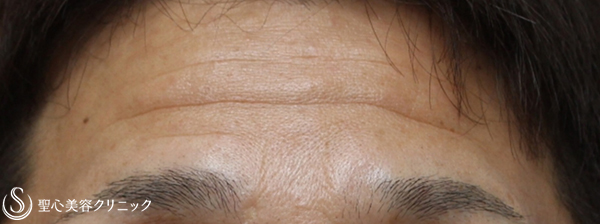 【40代男性・額のシワ改善】プレミアムPRP皮膚再生療法（3ヶ月後） Before 