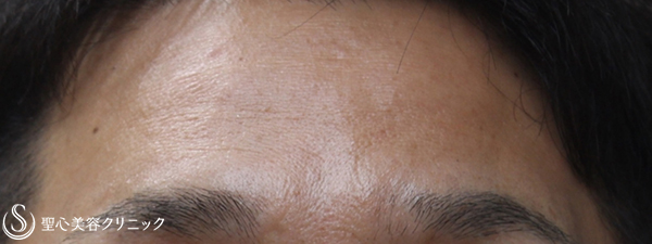 【40代男性・額のシワ改善】プレミアムPRP皮膚再生療法（3ヶ月後） After 
