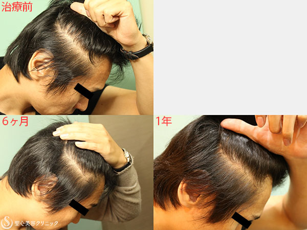 【30代男性・薄毛改善】毛髪再生トータルパッケージプラン（1年後） After 