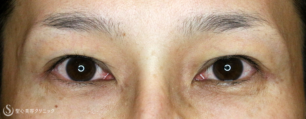 【40代女性・左右差のあるコンタクト性下垂】切らない眼瞼下垂+α法（2ヶ月後）札幌院 Before 