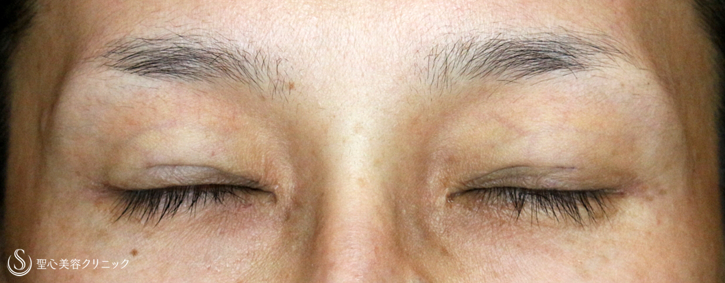 【40代女性・左右差のあるコンタクト性下垂】切らない眼瞼下垂+α法（2ヶ月後）札幌院 Before 