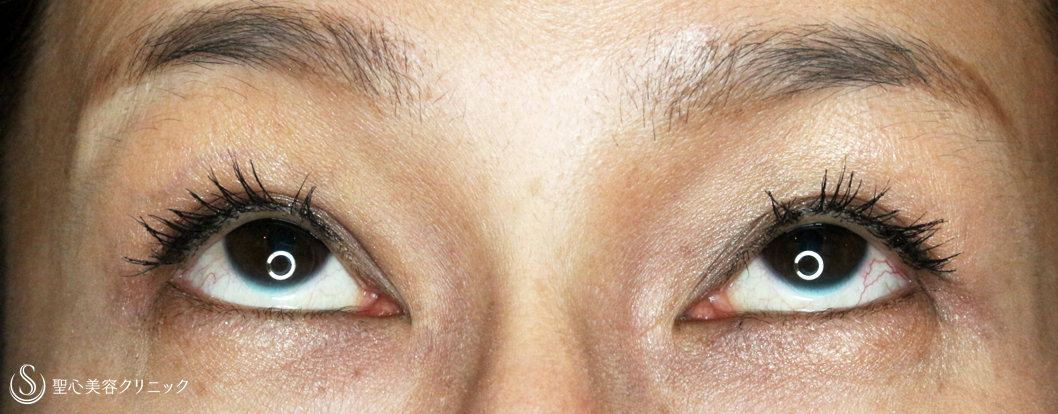 【40代女性・左右差のあるコンタクト性下垂】切らない眼瞼下垂+α法（2ヶ月後）札幌院 After 