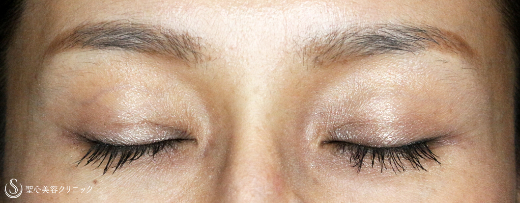 【40代女性・左右差のあるコンタクト性下垂】切らない眼瞼下垂+α法（2ヶ月後）札幌院 After 
