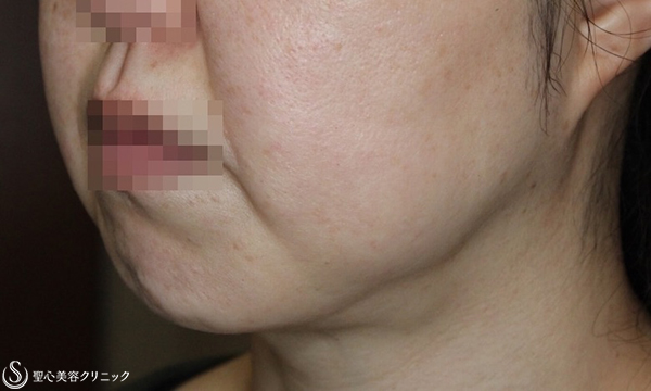 【40代女性・頬をすっきり】頬の脂肪吸引（ライト）（術後4ヶ月） Before 