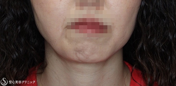【40代女性・頬をすっきり】頬の脂肪吸引（ライト）（術後4ヶ月） After 