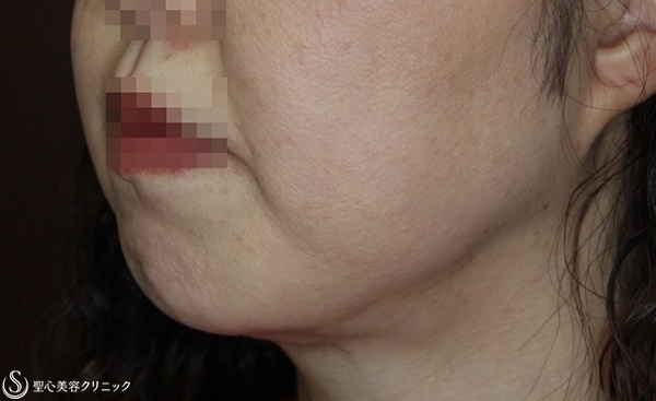 【40代女性・頬をすっきり】頬の脂肪吸引（ライト）（術後4ヶ月） After 