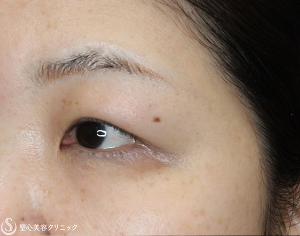 【40代女性・二重の左右差を改善】二重全切開＋脱脂（術後4ヶ月） Before 
